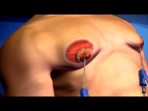 Male Breast Reduction in Nashik