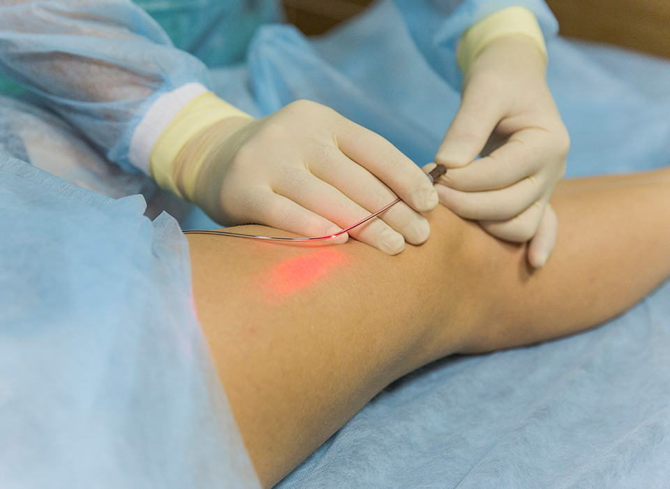 Laser treatment for varicose veins