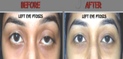 Eyelid surgery in nashik |Plastic surgery in nashik