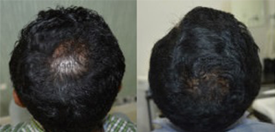 Hair growth treatment in nashik |Plastic Surgeon in nashik