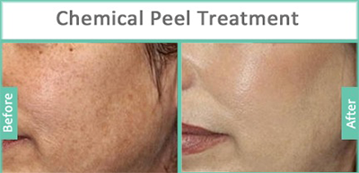 Chemical Peel Treatment in nashik | Plastic Surgeon in nashik | Symphony Clinics
