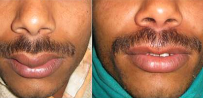 Lip augmentation in nashik | Plastic Surgeon in nashik | Symphony Clinics