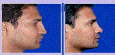 Rhinoplasty/nose job in nashik | Plastic Surgeon in nashik | Symphony Clinics