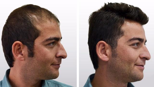 hair transplant in nashik