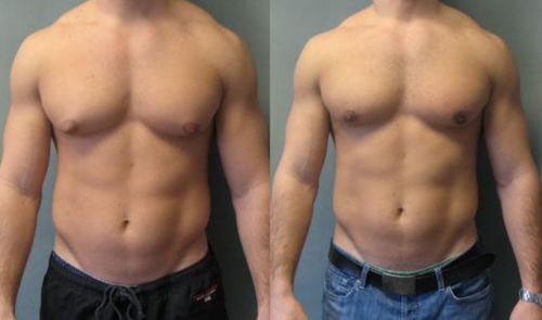 gynecomastia treatment in nashik | symphony clinic